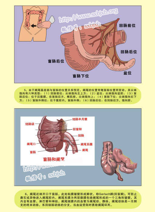 图解疾病 阑尾炎