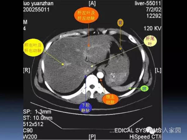肝脏分段及血管详细辨识教程(断层解剖 影像学)