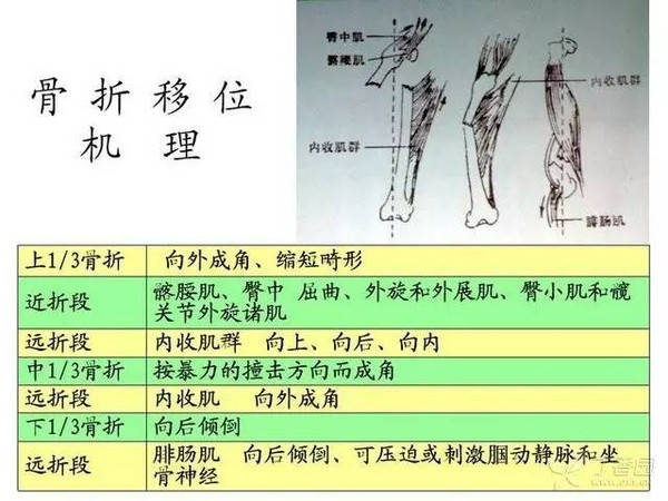 临床实用课件:股骨干骨折的