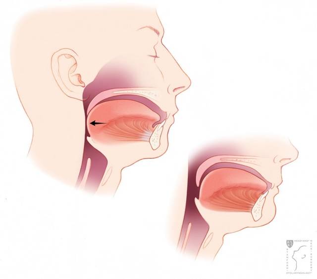 舌根和软腭构成了上呼吸道前部结构.