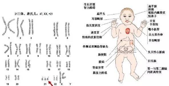 唐氏综合症,即21三体综合征,又称先天愚型或down综合征,是由常染色体