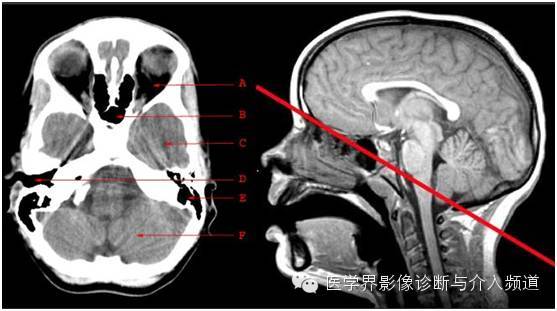 a=眼眶 b=蝶窦 c=颞叶 d=外耳道 e=乳突气房 f=小脑半球