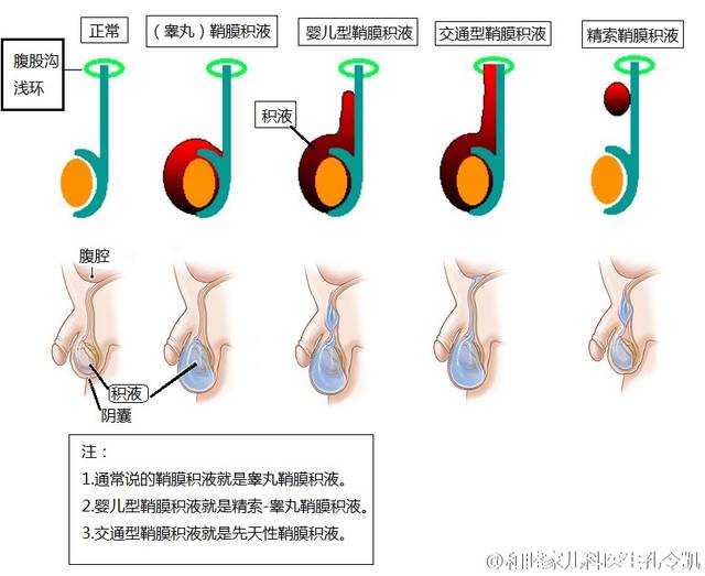 鞘膜积液按照解剖结构分为:睾丸鞘膜积液,精索鞘膜积液,婴儿型鞘膜