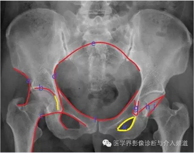 骨盆x片,这些径线你还记得吗?