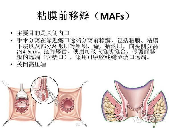 克罗恩病肛瘘诊治指南解读