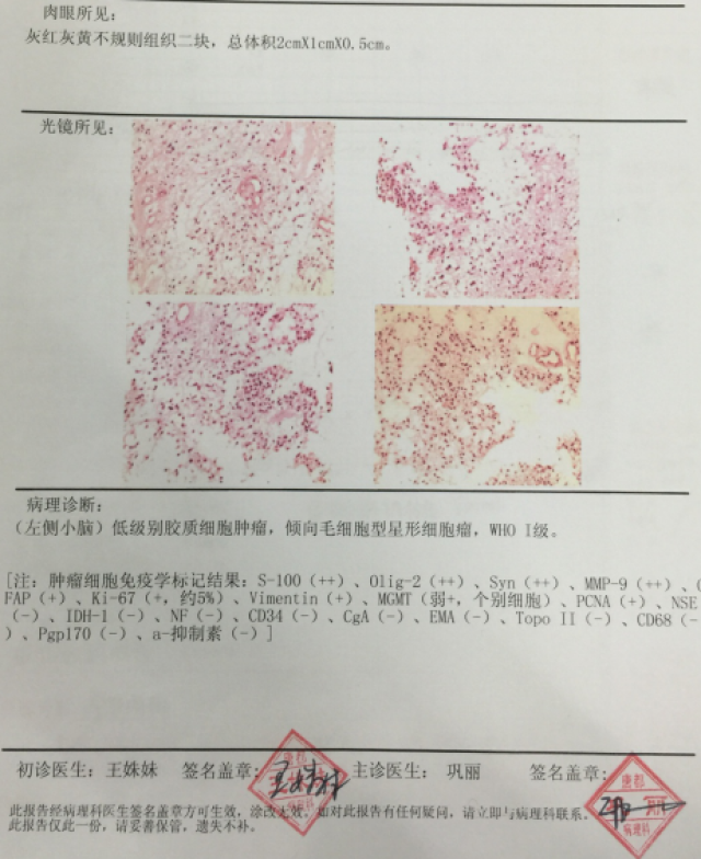 成功手术治疗小脑毛细胞型星形细胞瘤患者