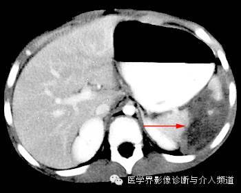 (脾破裂4级)