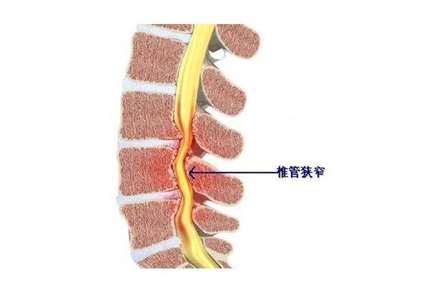 长圆针治疗腰椎间盘突出是什么原理(3)