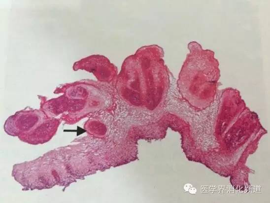 全方位解读:食管乳头状瘤