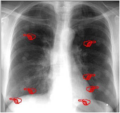 胸片显示:两肺多发的大小不等的结节影,形如棉花团.
