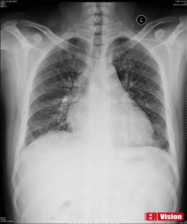 胸片:① 两肺纹理粗乱,考虑两肺炎症;② 右侧叶间胸膜增厚;③ 心影