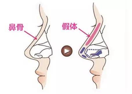 自体脂肪隆鼻是什么原理_自体脂肪隆鼻(3)