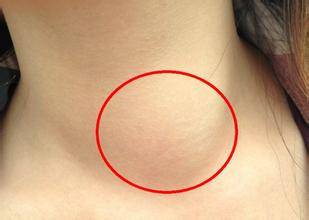 甲状腺肿大:俗称"粗脖子","大脖子"或"瘿脖子",它是以甲状腺的外观