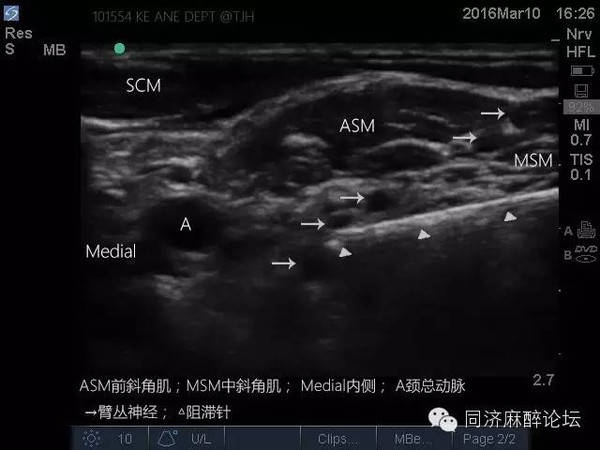 手把手教你"超声引导下臂丛神经阻滞"