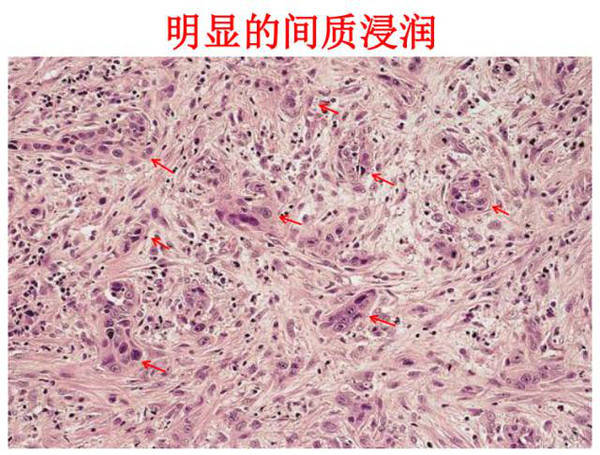 这是明显的间质浸润表现,间质内看到大量的团状小癌巢分布,伴有明显的