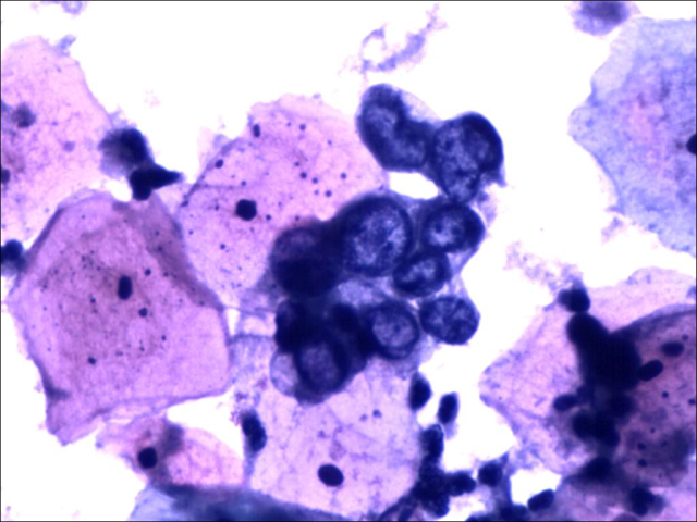 tct液基薄层细胞检测