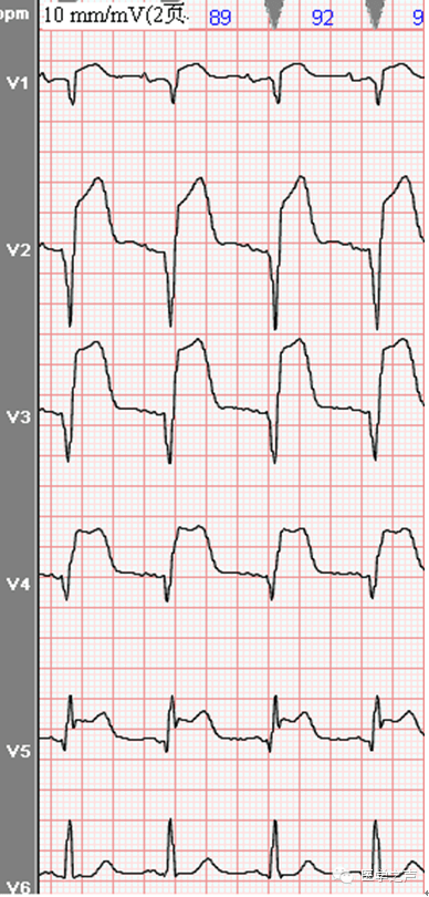 心电图课堂|第7期(下):急性心肌梗死的演变与定位