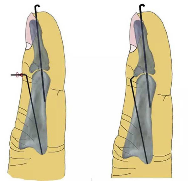 巧用克氏针治疗骨性锤状指