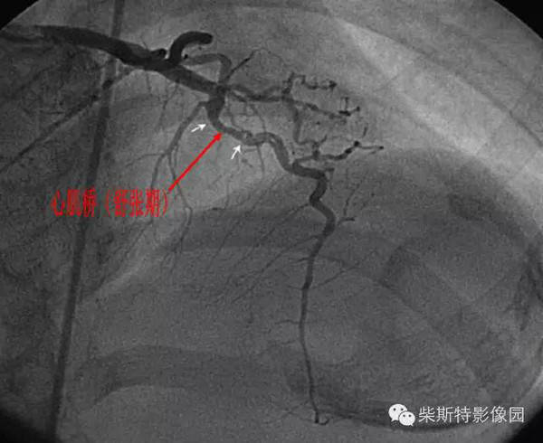 有了这些图解,还怕看不穿冠状动脉心肌桥?