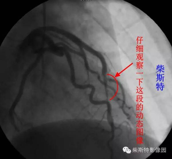 冠脉造影静态图像 标注:红色箭头指前降支中段心肌桥,伴夹层(蓝色