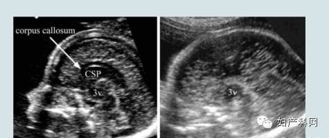 超声诊断:孕20周后 ①侧脑室呈"泪滴状"扩张,②第三脑室上抬,③透明隔