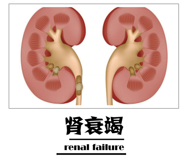 肾衰竭可分为急性肾衰竭及慢性肾衰竭,急性肾衰竭的病情进展快速