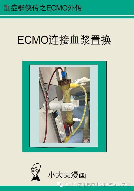 ecmo连接血浆置换