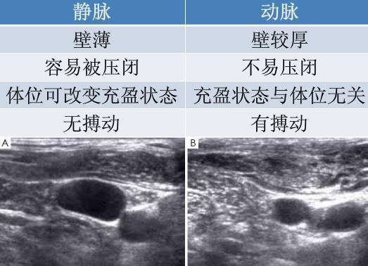 超声引导下中心静脉穿刺