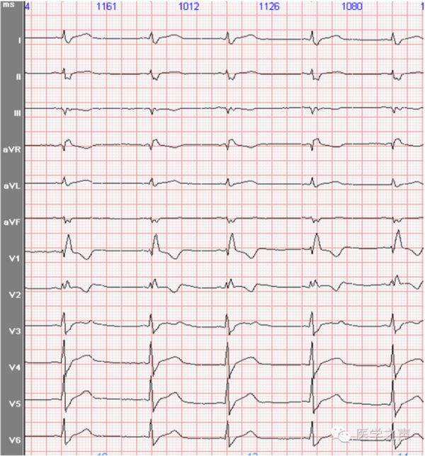 心电图课堂|第29期:完全右束支传导阻滞