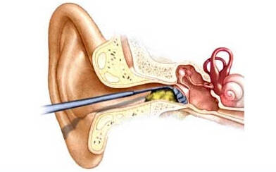 好处三:耳屎能保护耳膜; 幼儿教育专家提醒你,儿童的鼓膜比蝉翼还要