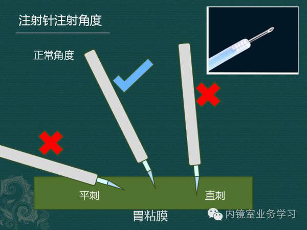 内镜常用注射针怎么用?