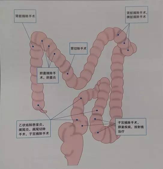 肠粘连患者肠道弯曲部位结肠镜插入的七点体会