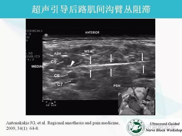 医院麻醉科授权转载 相关讲座:腰骶丛神经阻滞的操作技巧和临床应用