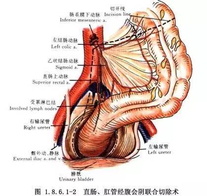 直肠前切除综合征是什么(三