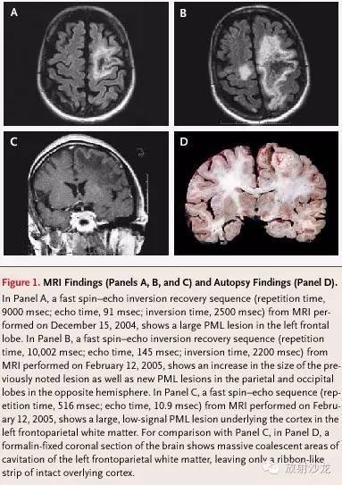 脑白质病变的影像学鉴别诊断