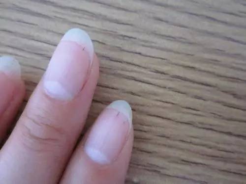 指甲上的小白点,到底是缺锌,缺钙还是有蛔虫?
