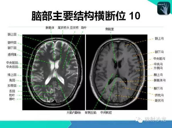 超详细!颅脑mri常用解剖