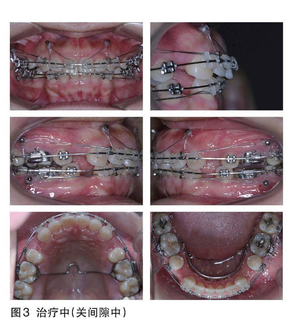 同时继续应用微螺钉种植体对上颌前牙及上下颌磨牙实施持续轻力压低