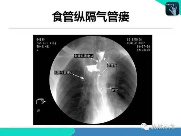 值得收藏的全套消化道钡餐图(食管,胃,小肠,结肠,直肠