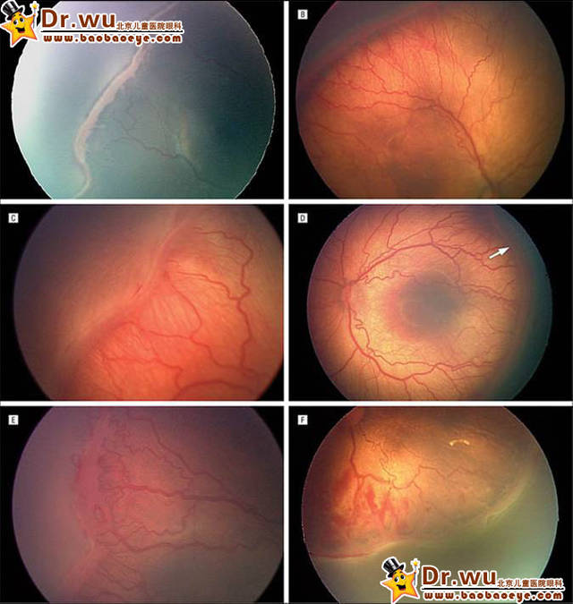 好爸科普2:早产儿视网膜病(rop)