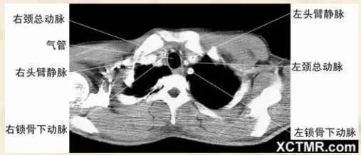 纵膈窗 胸骨切迹层面
