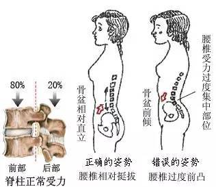 腰椎过度前凸,矫正"地基"很关键