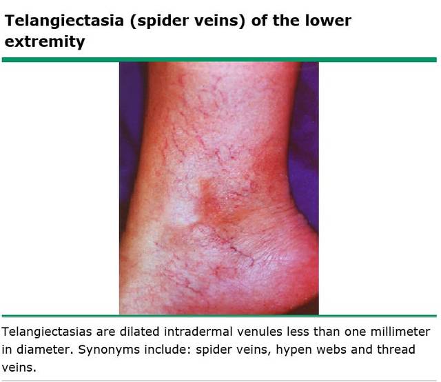 下肢毛细血管扩张