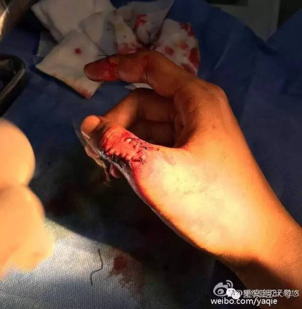 岳先生微博发布的被砍手指缝针照片.