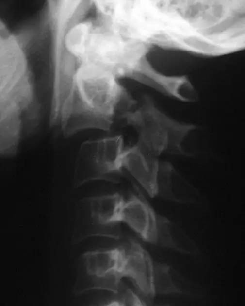 ct 扫描(b)(来源:radiopaedia) hangman 骨折 绞刑骨折,骨折通过第 2