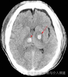 弥漫性轴突损伤(diffuse axonal injury,dai)是一种常见的脑损伤类型