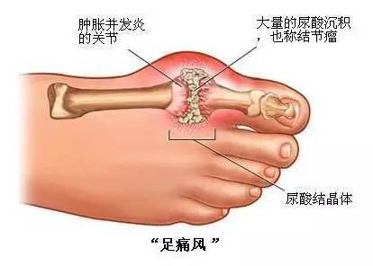 总犯痛风真不一定都是吃的