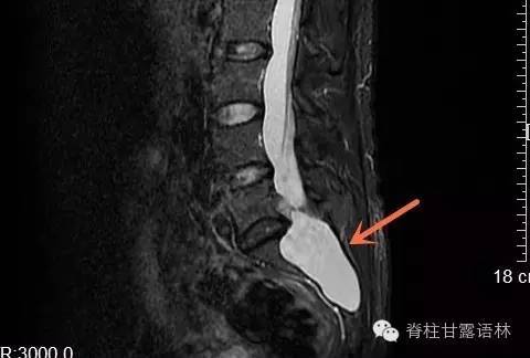 mri 为诊断骶管囊肿的金标准,界定囊肿与周围结构之关系,计划治疗