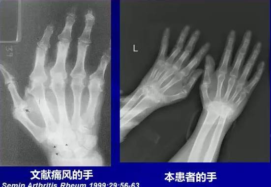 问题2:痛风能否造成关节间隙狭窄与天鹅颈畸形吗?