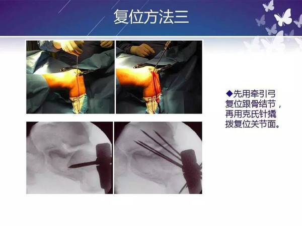 手术技术:跗骨窦切口治疗跟骨骨折